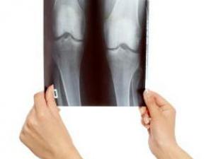Болит и ноет колено: причины и лечение Хирургический метод лечения