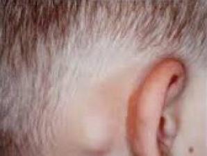 Воспаление лимфоузлов за ухом: причины и лечение